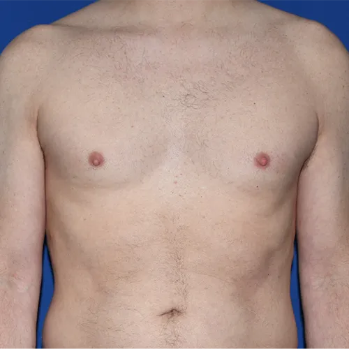Patient 03, front view before nipple correction