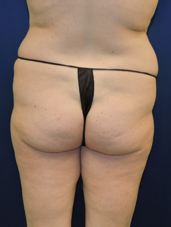 Patient 10, view 1 view before brazilian butt lift