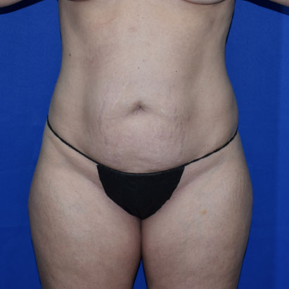 Patient 15, view 1 view before liposuction