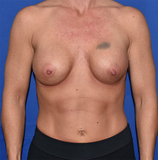 Patient 67, view 1 view before breast augmentation
