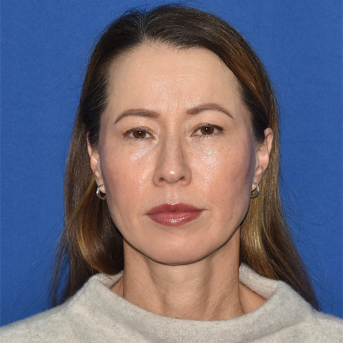 Patient 12, front view before blepharoplasty