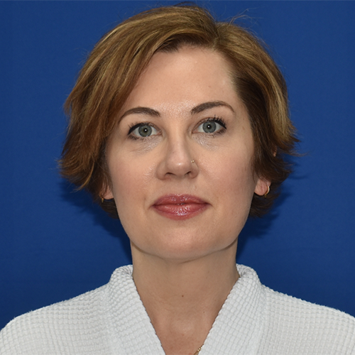 Patient 05, front view before blepharoplasty