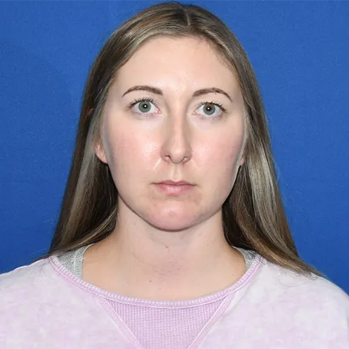 Patient 05, front view after chin augmentation