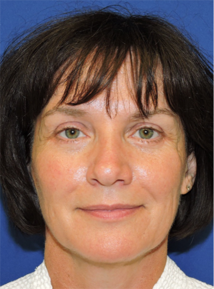 Patient 05, view 1 view after facial fat grafting