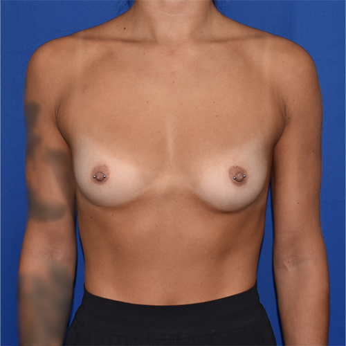 Patient 11, front view before breast augmentation