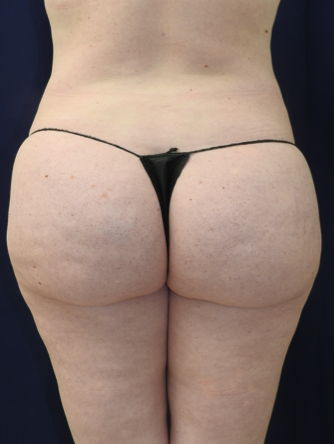 Patient 10, view 1 view after brazilian butt lift