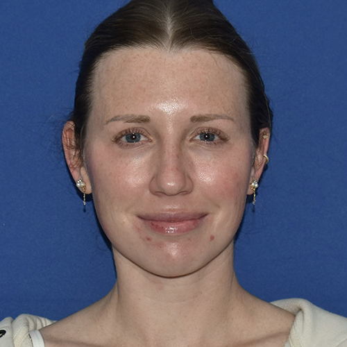 Patient 13, front view after chin liposuction