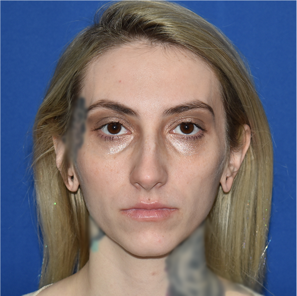 Patient 01, view 1 view before rhinoplasty