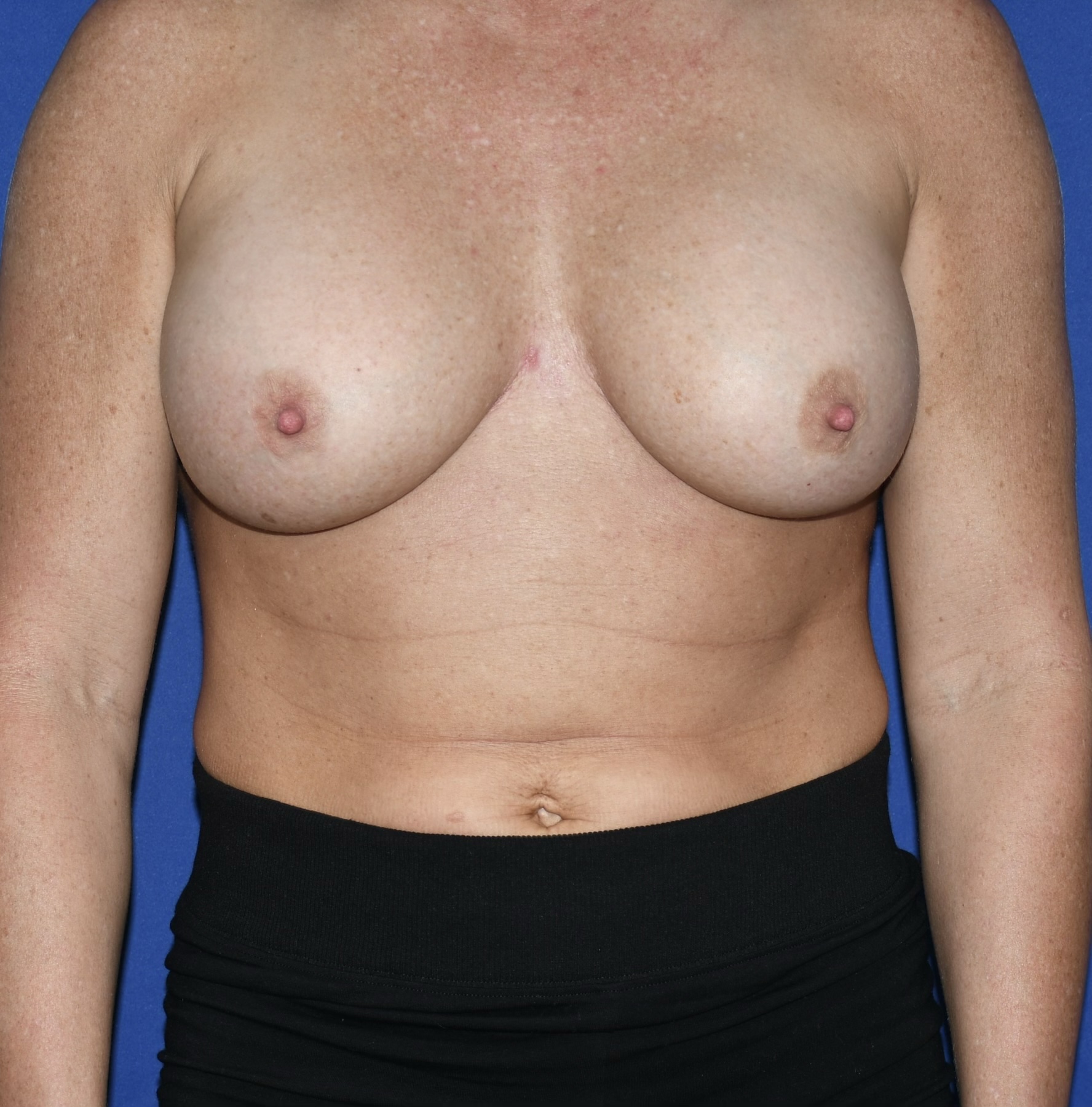 Patient 02, front view before breast implant revision