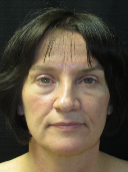 Patient 05, view 1 view before facial fat grafting