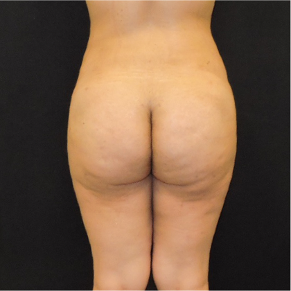 Patient 06, view 1 view after brazilian butt lift
