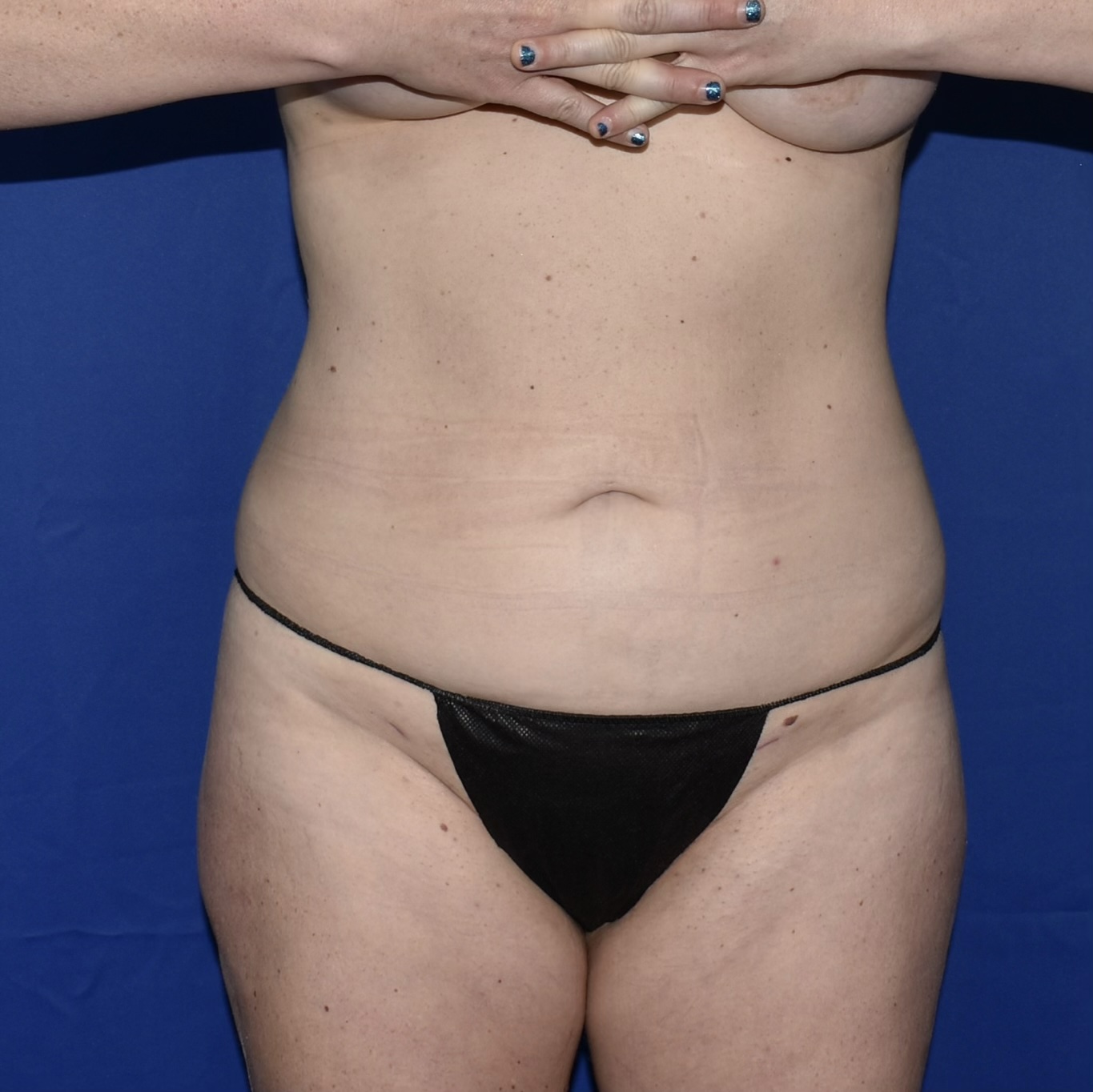 Patient 10, front view after liposuction