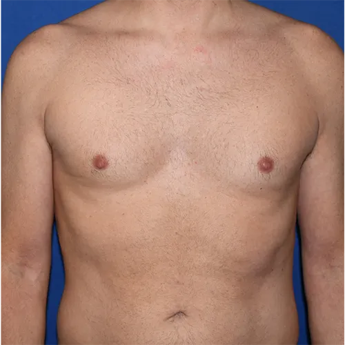 Patient 03, front view after nipple correction