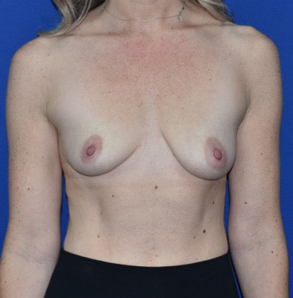 Patient 05, view 1 view before breast augmentation with lift
