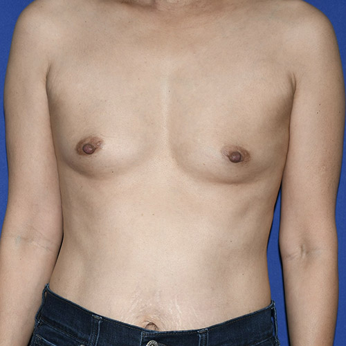 Patient 30, front view before breast augmentation