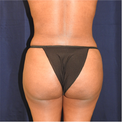 Patient 09, view 1 view after brazilian butt lift