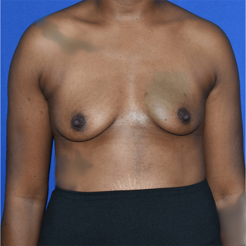 Patient 128, view 1 view before breast augmentation