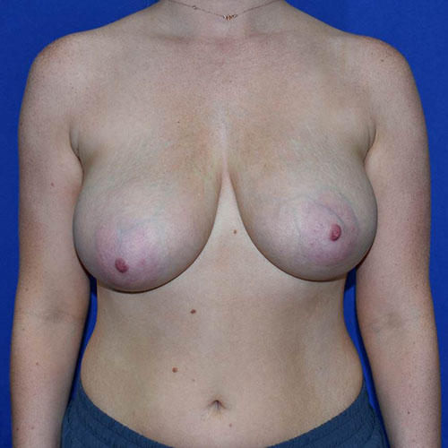 Patient 04, view 1 view before breast reduction