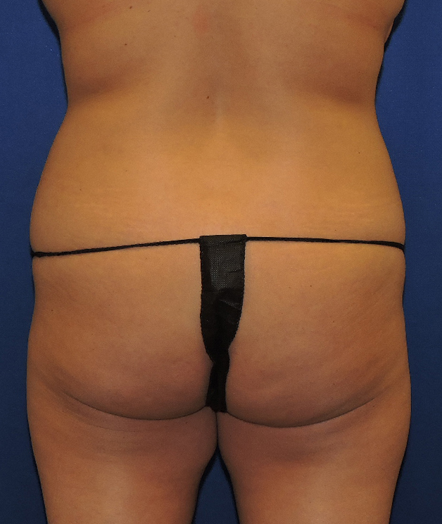 Patient 12, view 1 view before brazilian butt lift