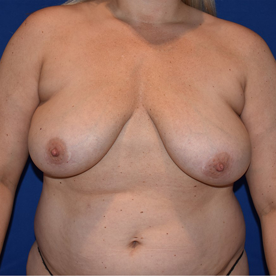 Patient 09, view 1 view before breast lift