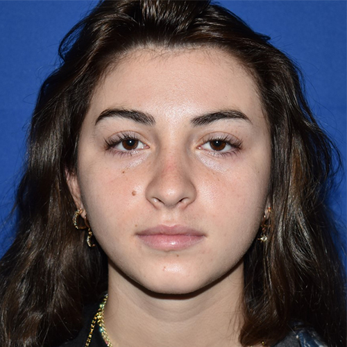 Patient 15, view 1 view after rhinoplasty
