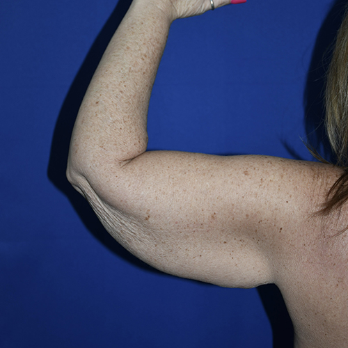 Patient 10, view 1 view before arm lift