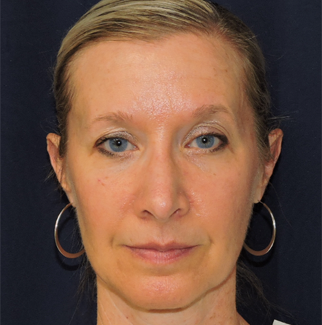 Patient 30, view 1 view after rhinoplasty