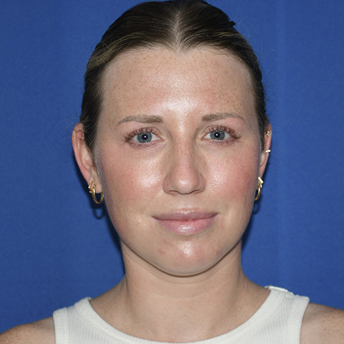 Patient 13, front view before chin liposuction