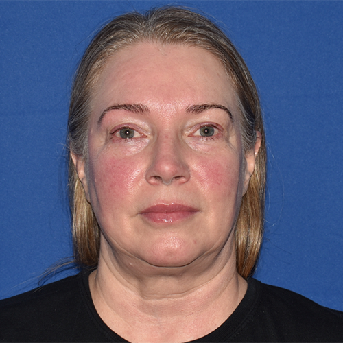 Patient 08, front view before blepharoplasty