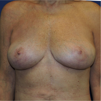 Patient 19, view 1 view after implant removal