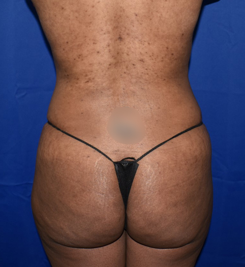 Patient 13, view 1 view after brazilian butt lift