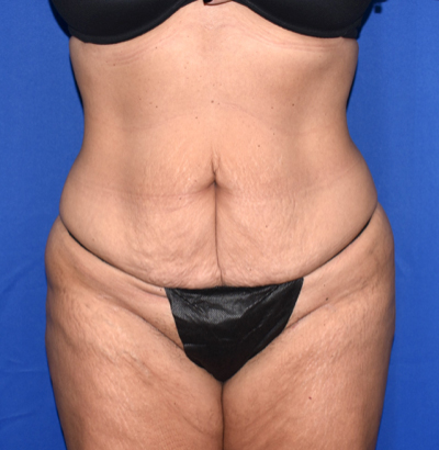 Patient 38, view 1 view before tummy tuck