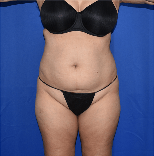 Patient 02, view 1 view before liposuction