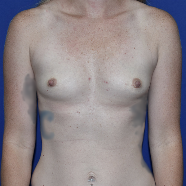 Patient 75, view 1 view before breast augmentation