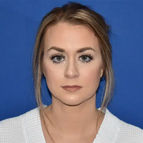 Patient 05, front view after chin liposuction