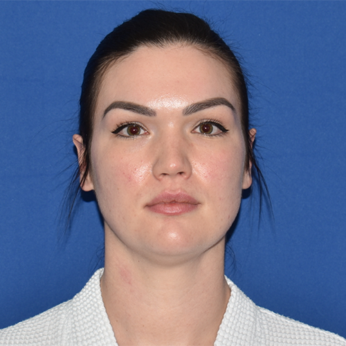 Patient 03, view 1 view before chin liposuction