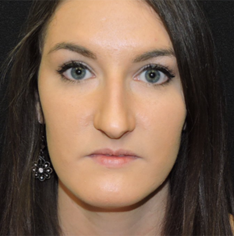 Patient 32, view 1 view before rhinoplasty