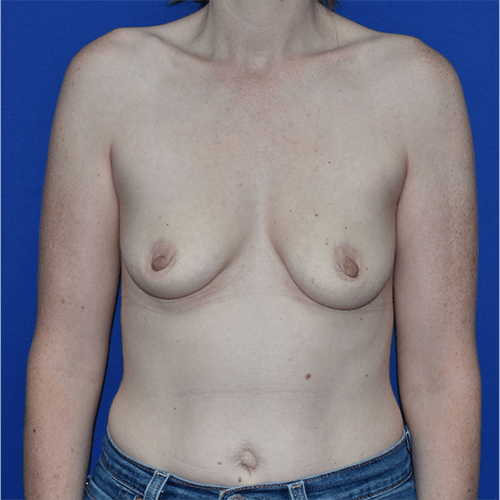 Patient 34, view 1 view before breast augmentation