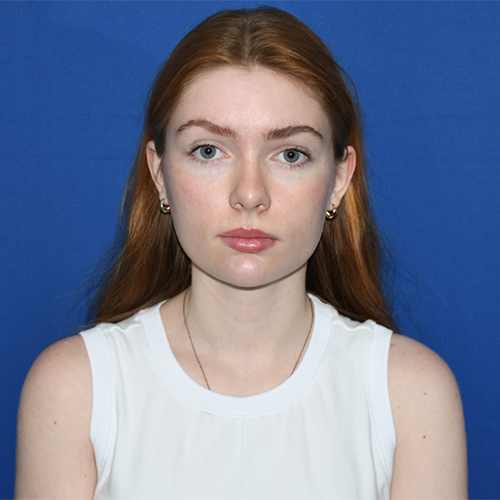 Patient 19, front view after chin liposuction
