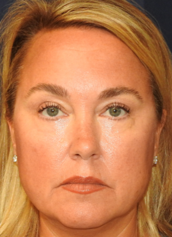 Patient 20, view 1 view after blepharoplasty