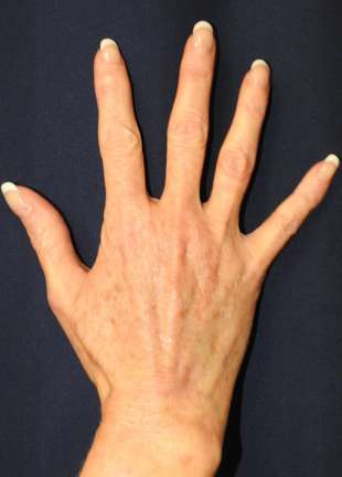 Patient 01, view 1 view after hand rejuvenation