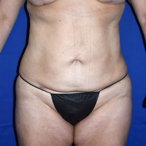 Patient 14, view 1 view after brazilian butt lift