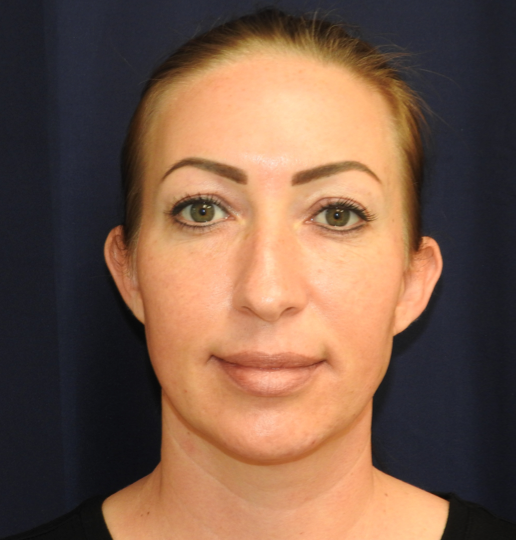 Patient 23, view 1 view before rhinoplasty
