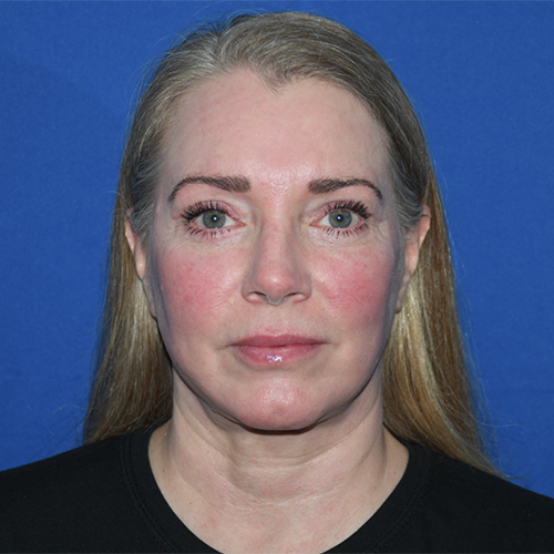 Patient 08, front view after blepharoplasty