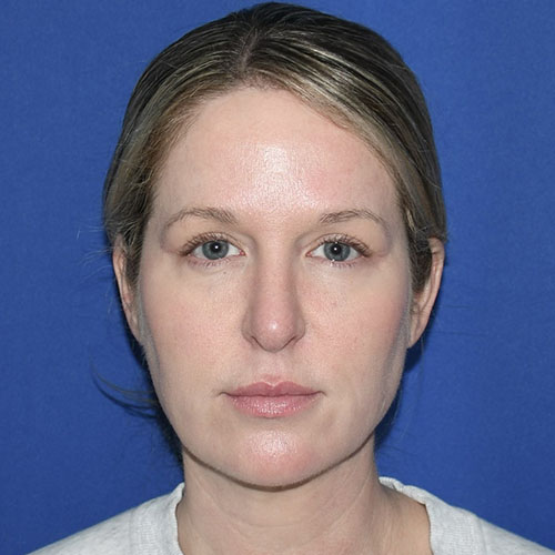 Patient 10, front view after rhinoplasty