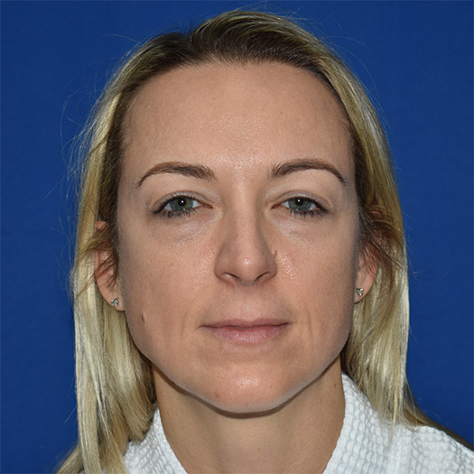 Patient 01, view 1 view before blepharoplasty