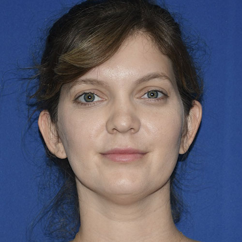 Patient 04, front view before chin liposuction