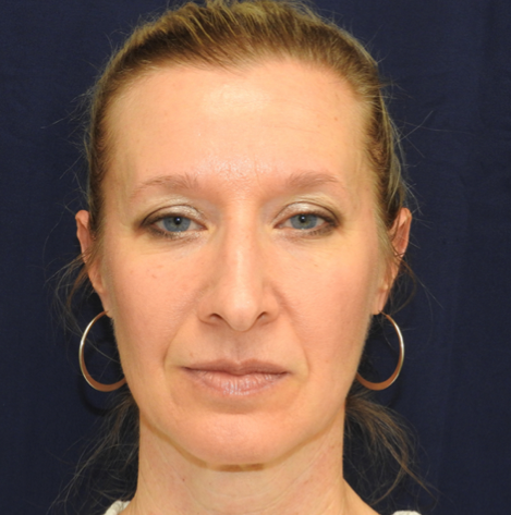 Patient 30, view 1 view before rhinoplasty