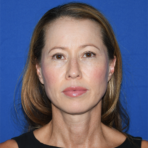 Patient 12, front view after blepharoplasty