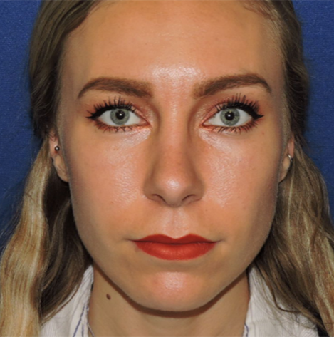 Patient 29, view 1 view after rhinoplasty